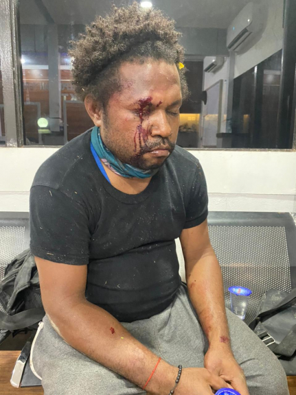Salah satu korban pengeroyokan atas nama Daud Yelimolo di salah satu asrama mahasiswa di Amban,  Manokwari, Papua Barat,  Rabu (17/2) malam. [Foto: ist]